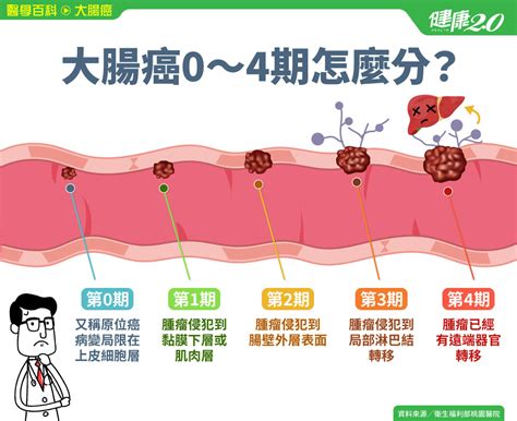 大腸癌／0～4期怎麼分？大腸癌可以活多久？4大治療方法一次詳解分期原位癌黏膜｜健康20