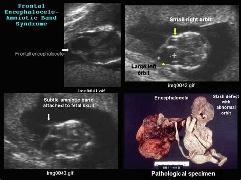 Ultrasound Of Cleft Lip And Palate Fetal Abnormalities Ultrasound