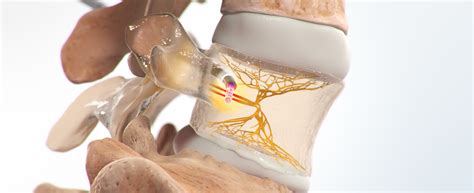 Intracept Procedure – Lowell Pain Center