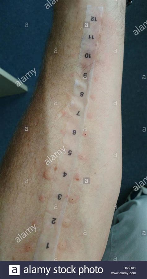 Drug eruption rash hi-res stock photography and images - Alamy