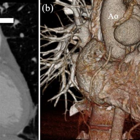 A Preoperative Computed Tomography Preoperative Computed Tomography