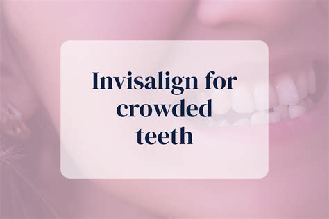 Trident Smiles Dental Can Invisalign Correct Crowding In Teeth