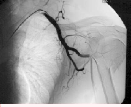 Angiography showing stenosis of axilla artery | Download Scientific Diagram