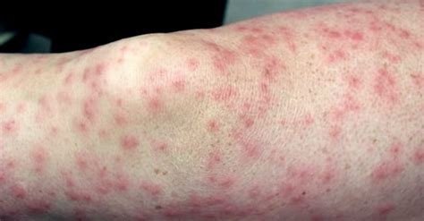 Allergic Contact Dermatitis Eczema