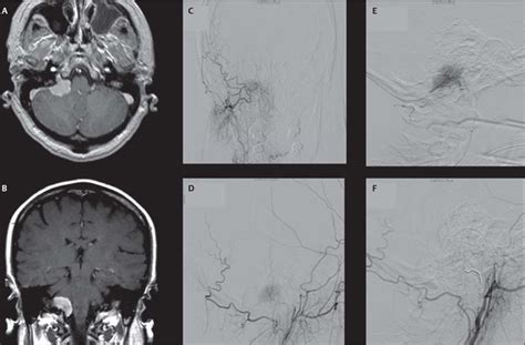 14 Diagnostic Evaluation And Embolization Of Meningiomas Neupsy Key