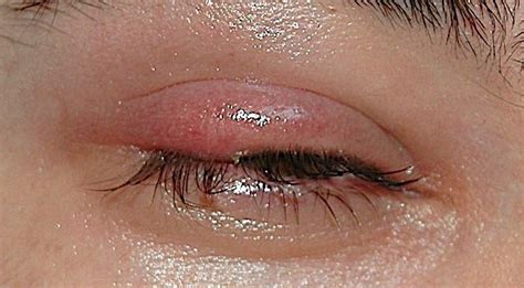 Stye on Your Eyelids? Here’s Everything You Need to Know - Eye Bulletin