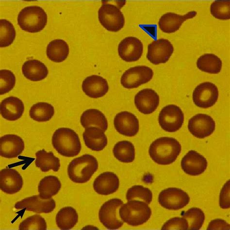 The peripheral blood smear of the patient showing microcytic ...