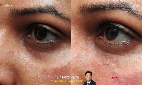 Cosmetic Dermal Filler Injection Dr Peter Kim Surgery Skin Cancer