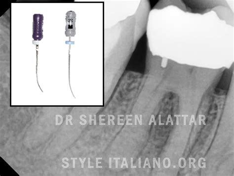 Clinical Tips For Managing Calcified Canals Style Italiano Endodontics