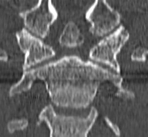 Understanding Os Odontoideum: A Radiology Case