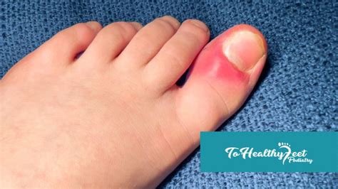 Ingrown Toenails To Healthy Feet Podiatry