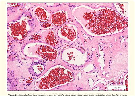 Figure From Primary Dumbbell Shaped Epidural Cavernous Hemangioma