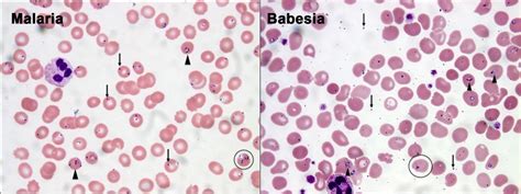 Malaria Babesia The American Journal Of Medicine Blog