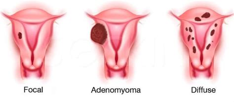 Adenomyosis, symptoms, causes and treatment. - Ultrasoundfeminsider