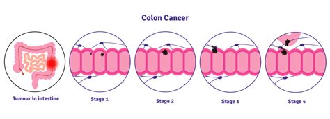 Colon Cancer - Regina GI