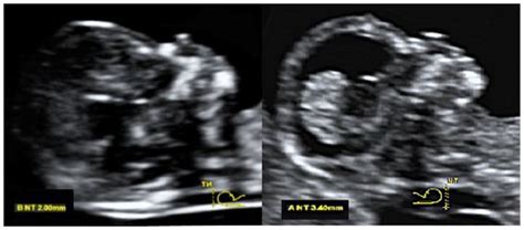 Measurement of Nuchal translucency in both fetuses. Measurement of... | Download Scientific Diagram