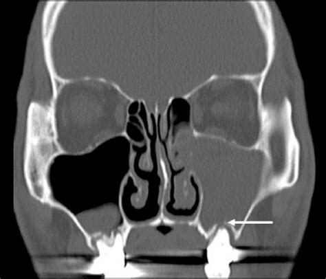 Ct Evaluation Odontogenic Origin Causing Obstructive Maxillary