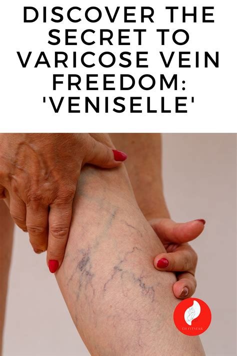 Get Rid Of Spider Veins In These 7 Natural Methods How To Get Rid Of Varicose Veins Naturall