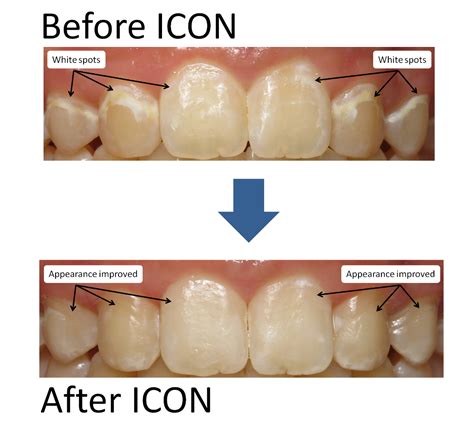 Icon White Spot And Discolored Tooth Treatment Preventative Dentistry