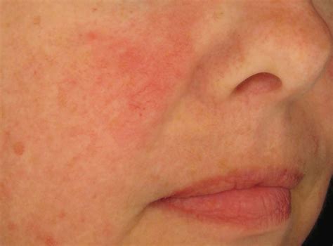 Types Of Rosacea Bumps And Pimples Flickr Photo Sharing