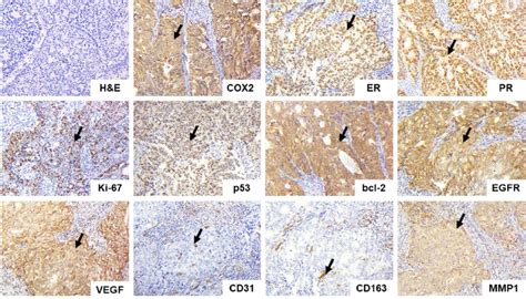 Endometrioid Endometrial Carcinoma Grade 3 Hematoxylin And Eosin Download Scientific Diagram