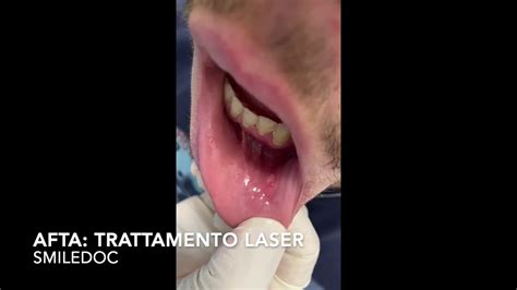 Terapia LASER Afta YouTube