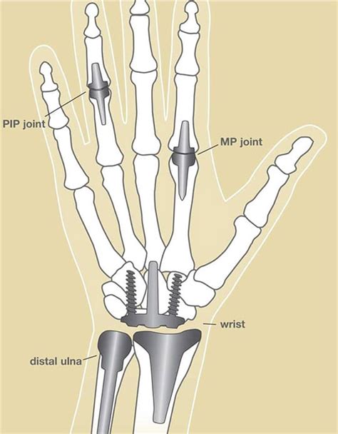 Finger Joint Replacement – Richard Stephen Gilbert, M.D.