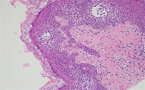 Histological Examination Of Punch Biopsy Revealed A Vesicular