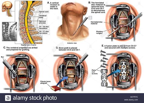 Spine Anatomy C5 C6