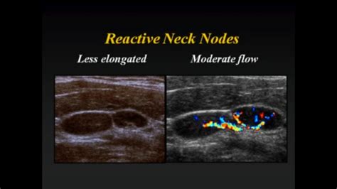 Cervical Lymph Nodes Ultrasound