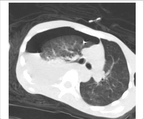 Chest spiral CT scan (lung window) after insertion of CVC and... | Download Scientific Diagram