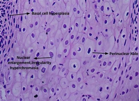 Koilocytes