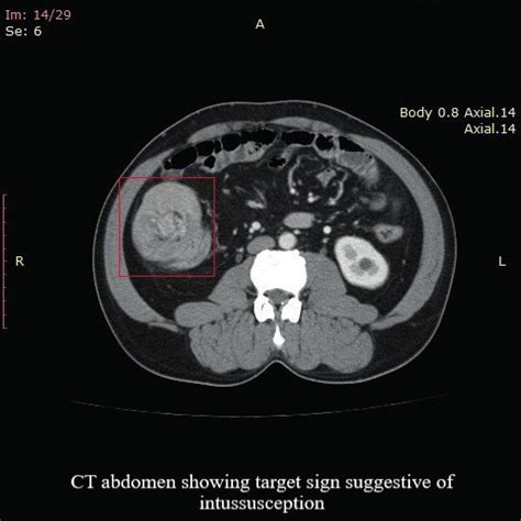 Ct Scan With Ileocaecal Intussusception Download Scientific Diagram