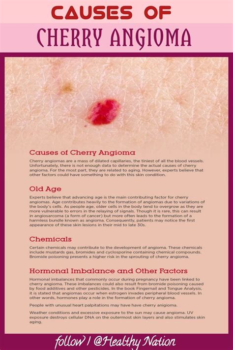 Causes Of Cherry Angioma Cherry Angioma Healthy Life Hacks Red Moles