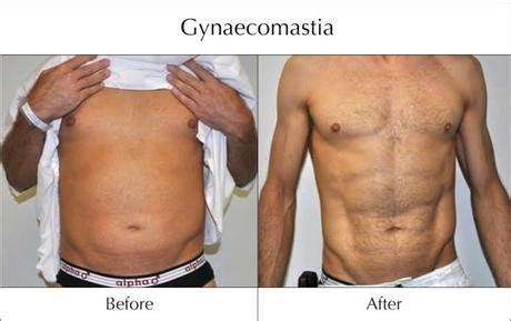 Top Myths About Gynecomastia Surgery In India Paperblog