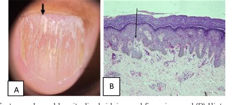 Pdf A Rare Case Of Nail Lichen Planus Semantic Scholar