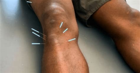 Frequently Asked Questions About Dry Needling Back In Motion