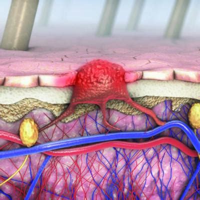 Dermoscopy, other modalities for improving melanoma diagnoses reviewed ...