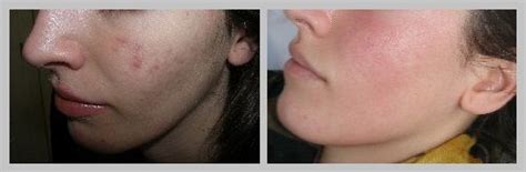 Como Tratar El Acne Hormonal En Mujeres