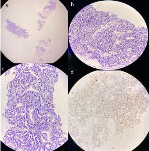 A Low Power View With Hande Staining Showing No Normal Liver Tissue