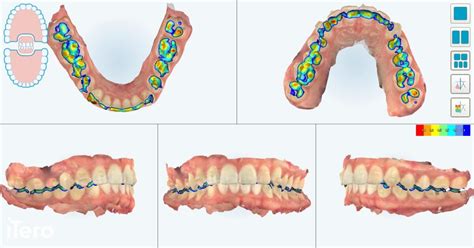 De Ce Iubim Scannerul Intraoral Itero Ortoestetic