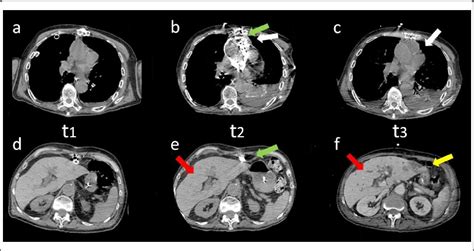 Figure 1 From A Case Report Of A Mediastinal Fistula With Liver Abscesses As A Complication Of