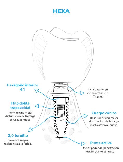 Hex Gono Externo Kopp Sistema De Implantes