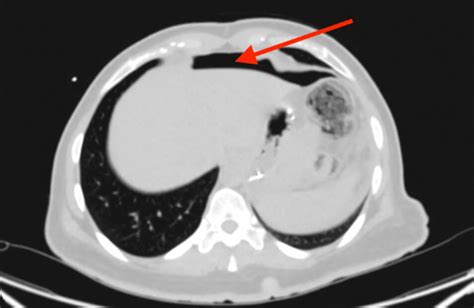 Perforated Marginal Ulcer Post Roux En Y Surgery Without Risk Factors