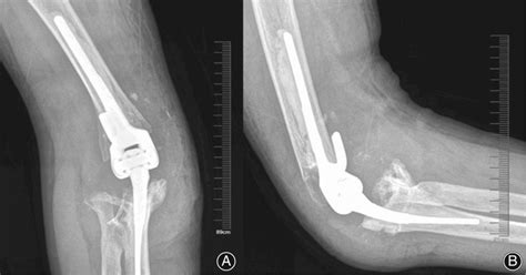 The X‐ray of elbow joint of case 1 at 6 months after operation, showing... | Download Scientific ...