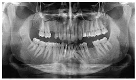 Reports Free Full Text Primary Intraosseous Squamous Cell Carcinoma