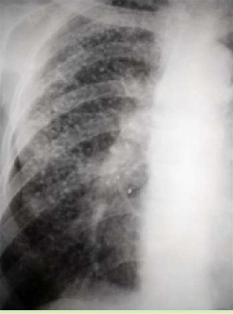 Silicosis Eggshell Calcification