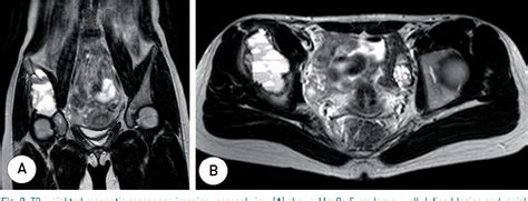 Figure 1 from Primary Aneurysmal Bone Cyst in the Iliac Bone: A Case ...