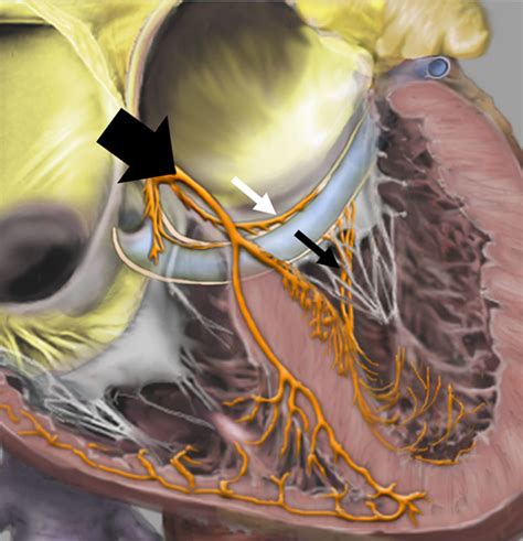 Ablation Of Supraventricular Tachycardias From Concealed Left Sided