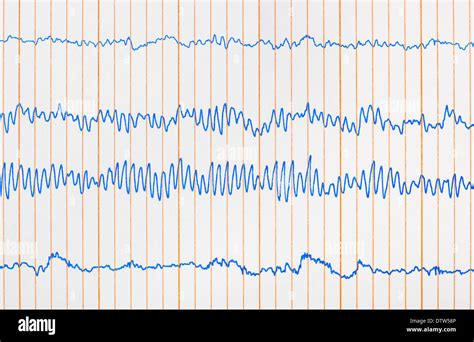 Electrocardiogram Ecg Hi Res Stock Photography And Images Alamy